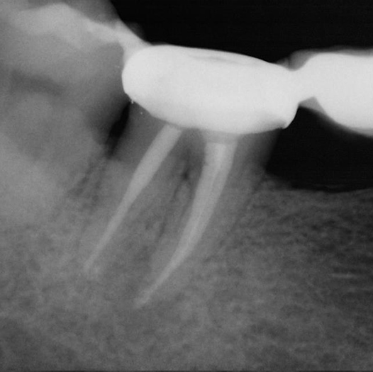 After Root Canal treatment