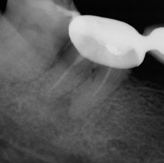 Before Root Canal treatment