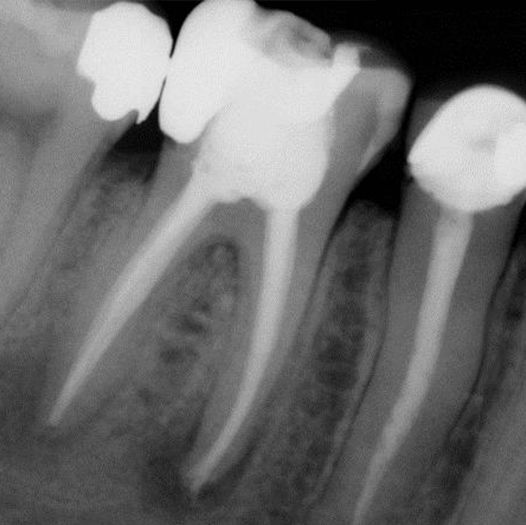 After Root Canal treatment