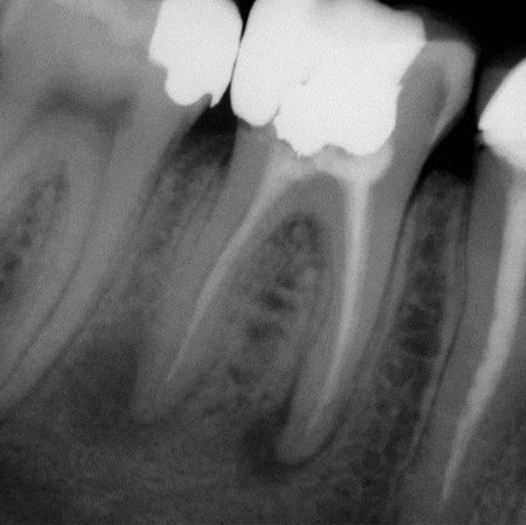 Before Root Canal treatment