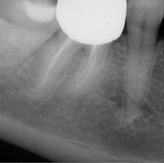 Before Root Canal treatment