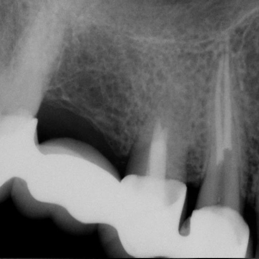 After Root Canal treatment