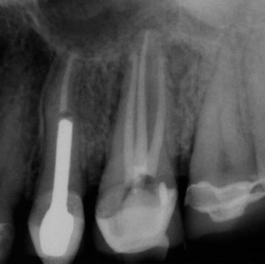 After Root Canal treatment