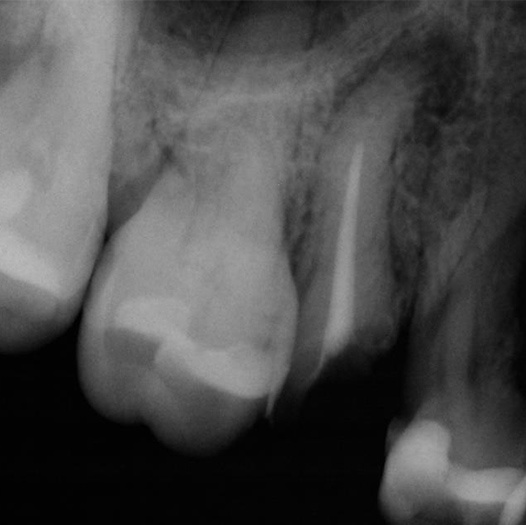 Before Root Canal treatment