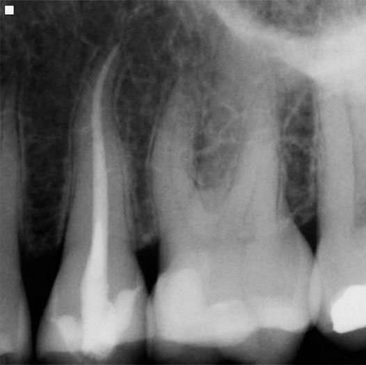 After Root Canal treatment